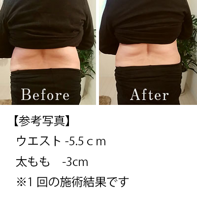痩身・ウエスト痩せ