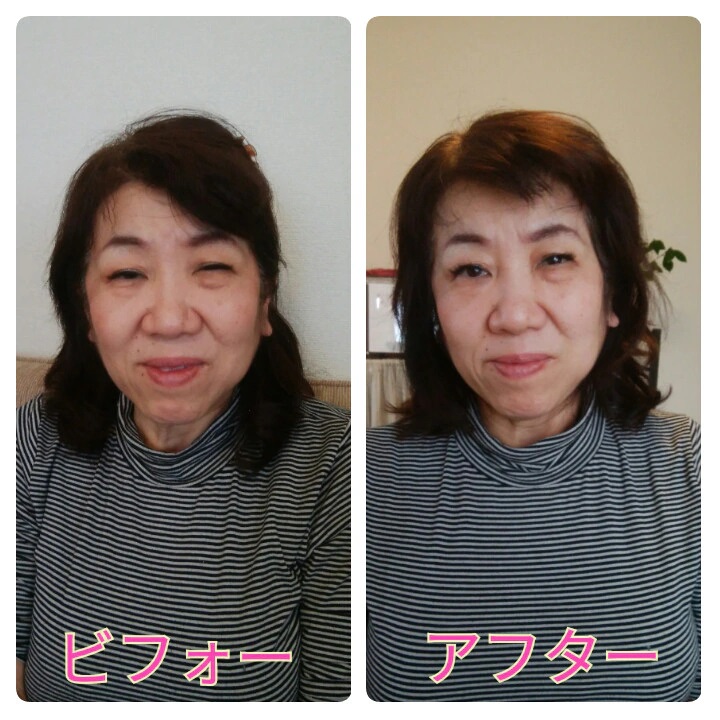 小顔矯正